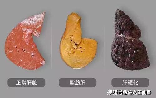 男子酒足饭饱后突发脑干出血,一场突如其来的健康警报 男子酒足饭饱后突发脑干出血,一场突如其来的健康警报
